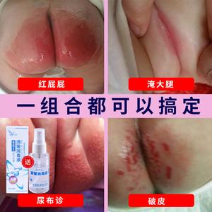 借卵代孕宝宝红屁股用什么好