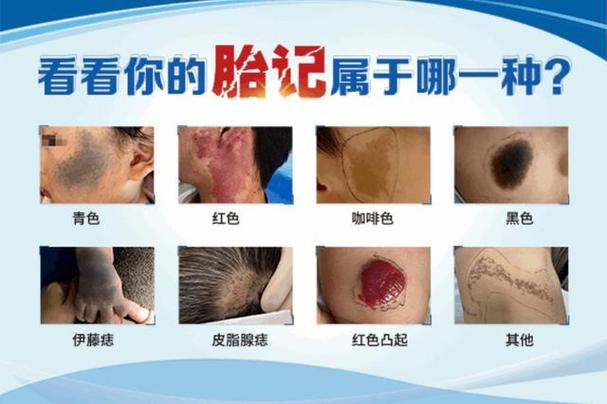 代孕妈妈宝宝为什么有胎记