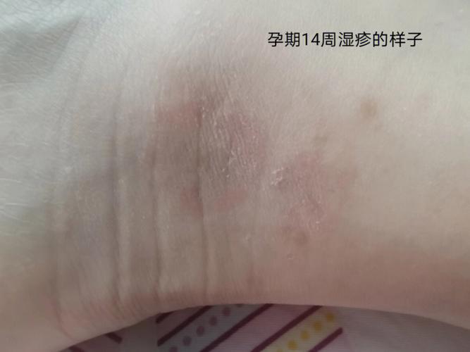 为什么借卵代孕宝宝的湿疹